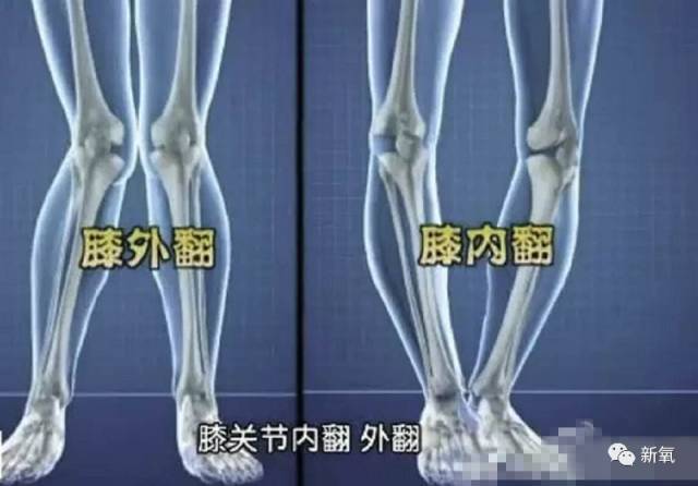 膝盖 膝盖没长好,正面看是不是会特别不直,更严重的会膝外翻造成x型