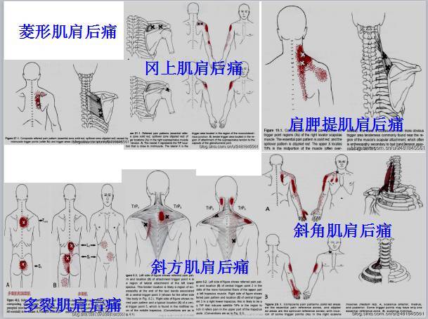 全身激痛点分布速查手册