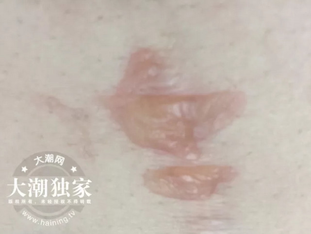 女子因痛经想保暖 用了暖宝宝皮肤却被烫伤