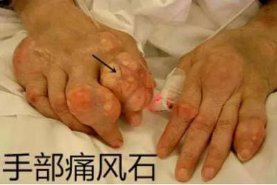 布洛芬等nsaids;(1)首选秋水仙碱;2,痛风急性发作期(2)碱化尿液:碳酸
