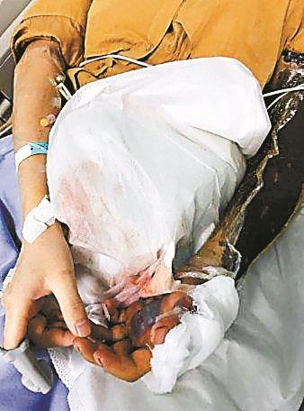 可怕!深圳女子围观同事杀蛇反被咬伤