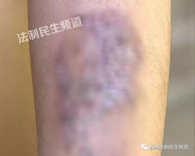 株洲一男子为了工作洗掉纹身 没想到换来这样
