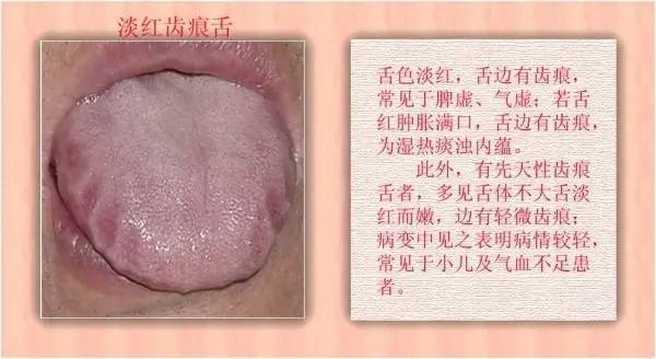 女性,常伴有胸闷,恶心欲吐的症状,舌质淡红,舌体边缘见齿痕,舌苔白腻