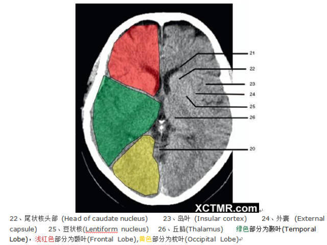 颅脑ct解剖图及供血分区