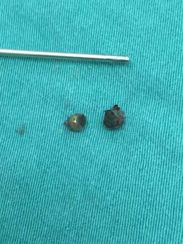 宁波小男孩反复流鼻涕 因3年前吸入了奖励贴