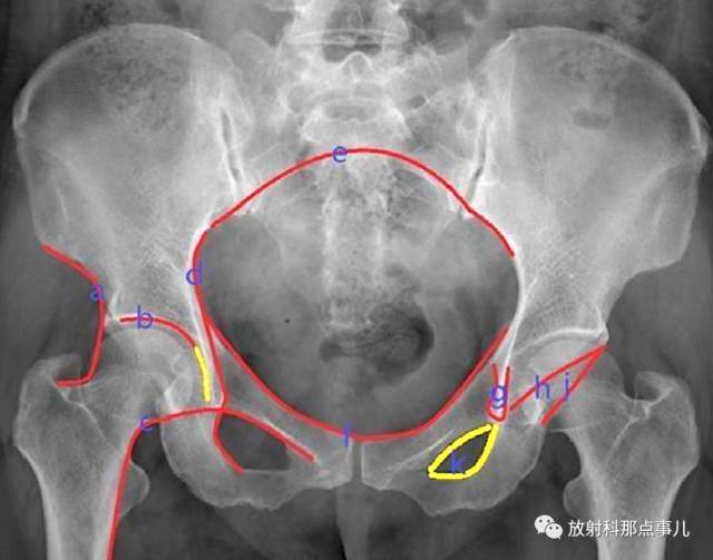 骨科精读髋关节的x线解剖及应用技巧最全总结