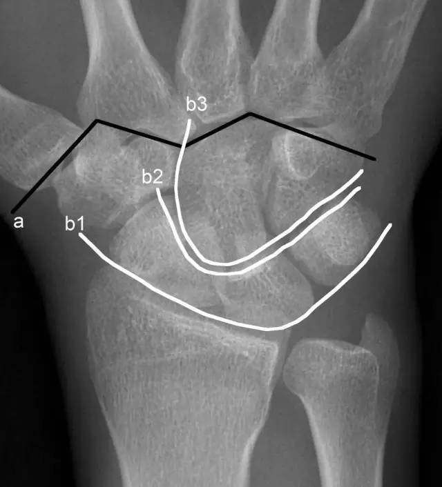腕关节x线阅片技巧