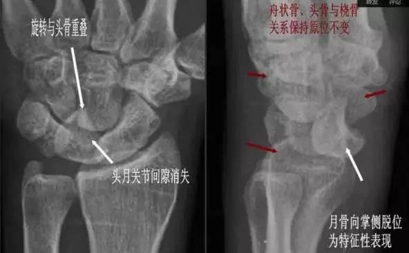 月骨脱位影像特点