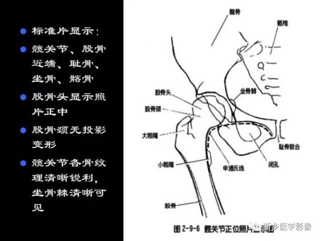 骨科精读|髋关节的x线解剖及应用技巧,最全总结!