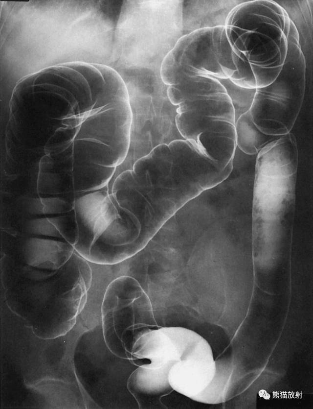 ileocecal, 横结肠,5 descending colon 降结肠,6 haustra 结肠袋,7 ileocecal
