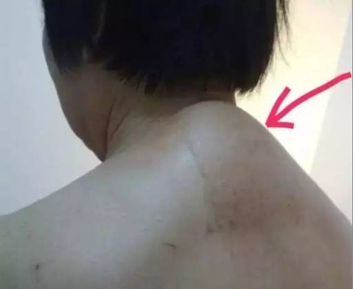 刮痧 艾灸除