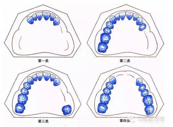 一文教你读懂肯氏kennedy分类法
