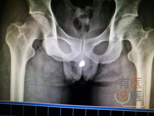 男子把锁头从尿道塞进膀胱 锁加上锁柄长达2厘米_大渝网_腾讯网