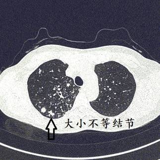 ct诊断肺结核宝典这是我见过的最好的经验总结