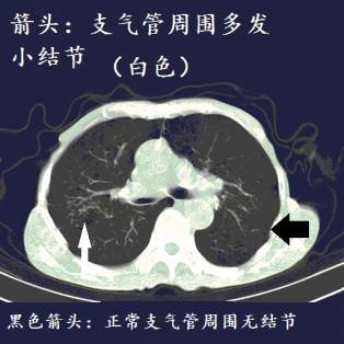 ct诊断肺结核宝典这是我见过的最好的经验总结