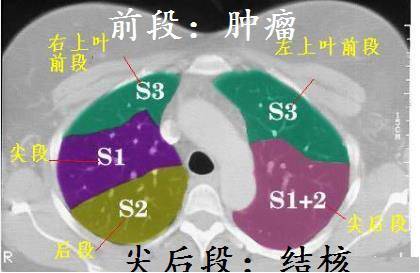 导致局部抵抗力低,并且,这些部位氧气多,结核是需氧菌,在上叶的尖后段