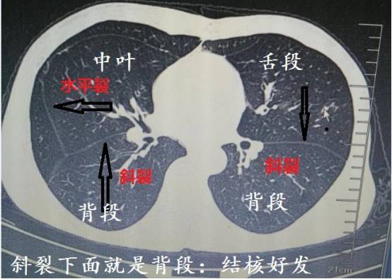 导致局部抵抗力低,并且,这些部位氧气多,结核是需氧菌,在上叶的尖后段