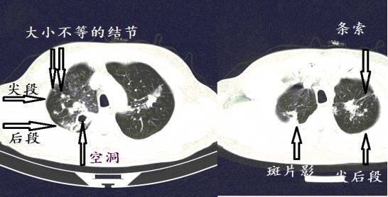 ct诊断肺结核宝典这是我见过的最好的经验总结