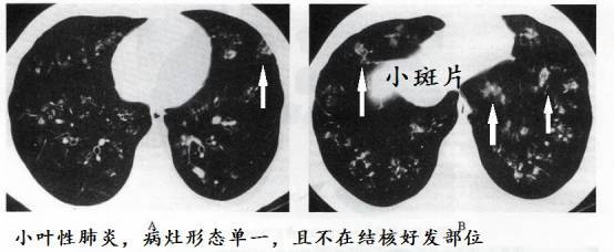 ct诊断肺结核宝典这是我见过的最好的经验总结