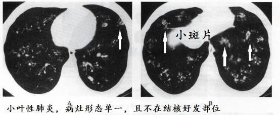 ct诊断肺结核宝典:这是我见过的最好的经验总结!