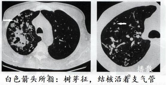 ct诊断肺结核宝典这是我见过的最好的经验总结