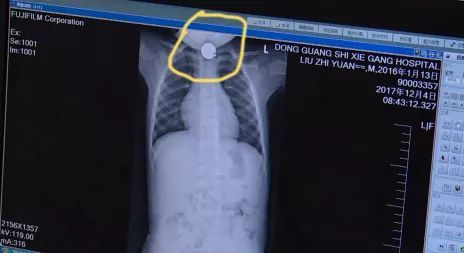 謝崗2歲男童吞下兩枚硬幣 使勁吐口水