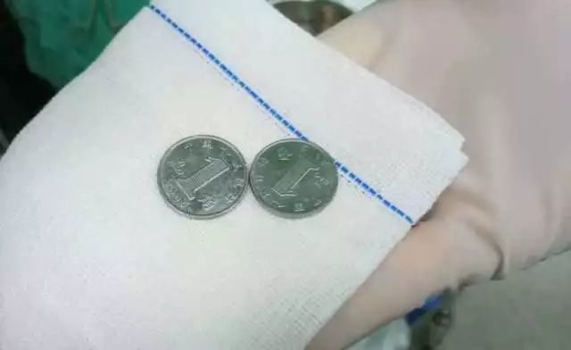 謝崗2歲男童吞下兩枚硬幣 使勁吐口水