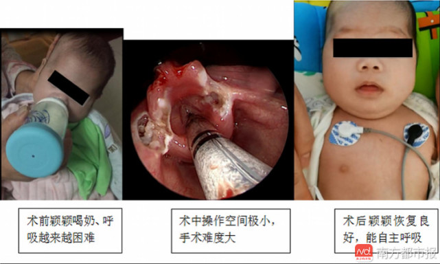 世以呼吸机和镇定剂维生!深圳苦命娃用鼻子喝奶