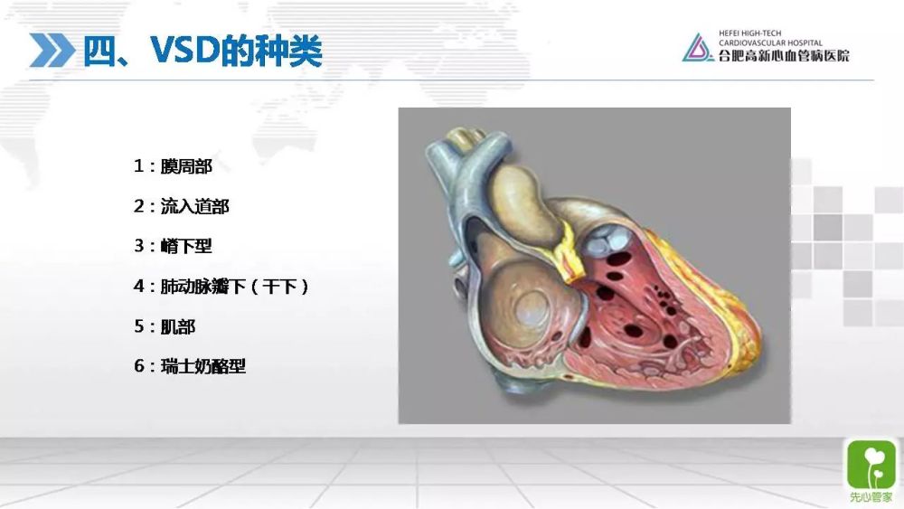 讲座回顾 | 室间隔缺损手术年龄与手术方式的最佳选择