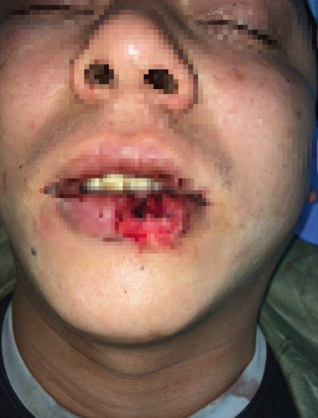 不忍直视!广州烧烤店老板被朋友咬掉一块嘴唇