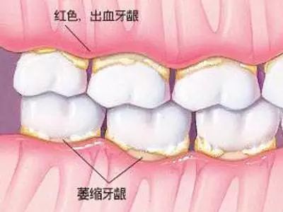 此外,砷,汞,铅中毒也导致牙龈萎缩,需要留意工作和生活环境,尽量避免