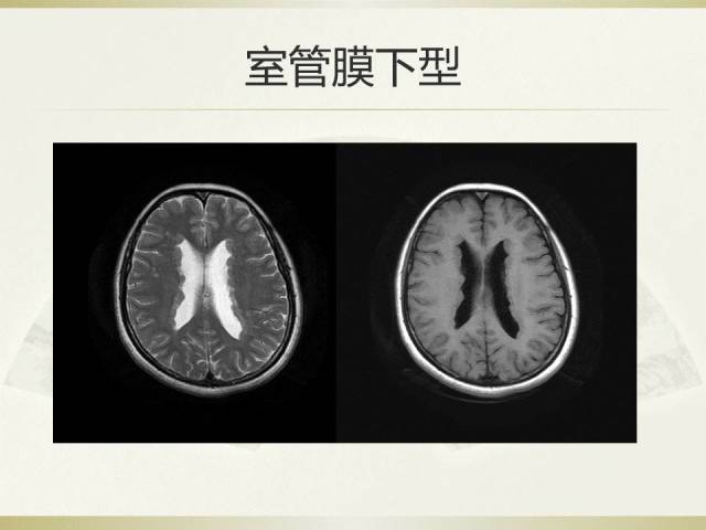 脑灰质异位的临床及mri诊断