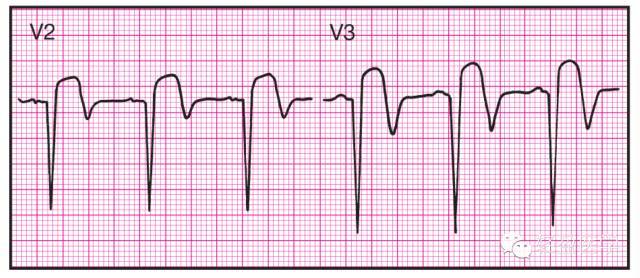 学习必备ii常见心电图图文参考