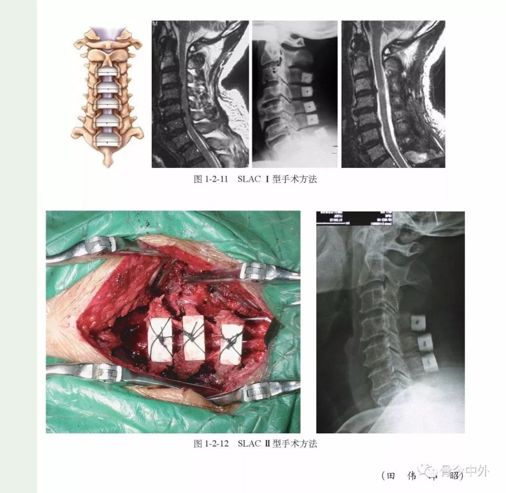 颈椎退行性疾病:分类,临床表现,影像学诊断及治疗(经典实用,人手一份)