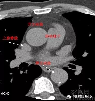 影像解剖|心脏冠状动脉ct解剖中文详细标注(图文)