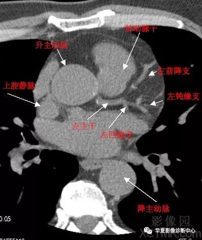 影像解剖心脏冠状动脉ct解剖中文详细标注图文