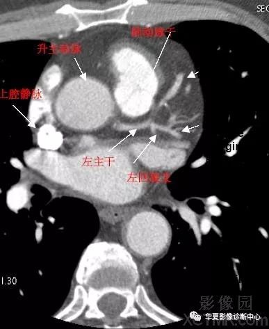 影像解剖|心脏冠状动脉ct解剖中文详细标注(图文)