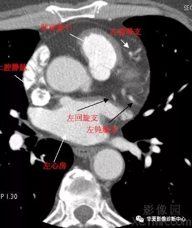 影像解剖|心脏冠状动脉ct解剖中文详细标注(图文)
