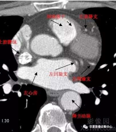 影像解剖|心脏冠状动脉ct解剖中文详细标注(图文)