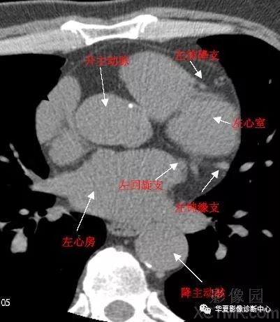 影像解剖|心脏冠状动脉ct解剖中文详细标注(图文)