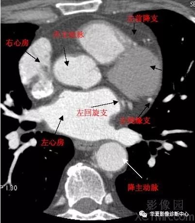 影像解剖|心脏冠状动脉ct解剖中文详细标注(图文)