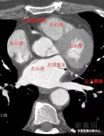 影像解剖|心脏冠状动脉ct解剖中文详细标注(图文)