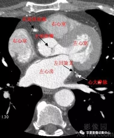 影像解剖|心脏冠状动脉ct解剖中文详细标注(图文)