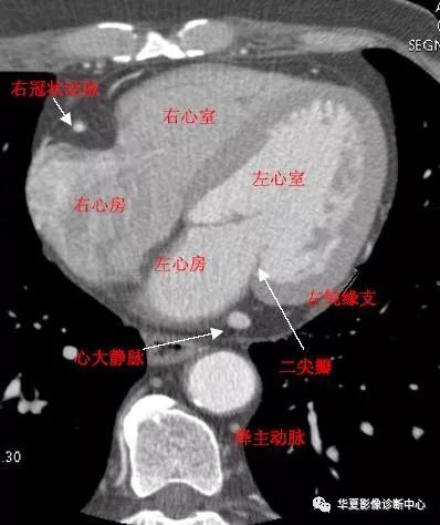 影像解剖|心脏冠状动脉ct解剖中文详细标注(图文)