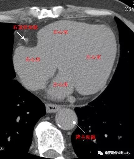 影像解剖心脏冠状动脉ct解剖中文详细标注图文