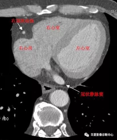 影像解剖|心脏冠状动脉ct解剖中文详细标注(图文)
