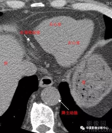 影像解剖|心脏冠状动脉ct解剖中文详细标注(图文)