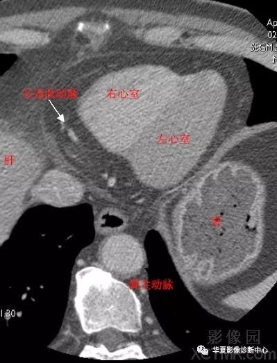 影像解剖|心脏冠状动脉ct解剖中文详细标注(图文)