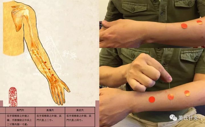 董氏奇穴痔疮治疗