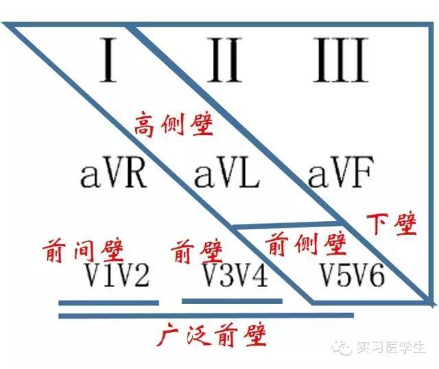 电解质紊乱:低血钾:u波增高,或tu融合,双峰,看v2,v3导联st段压低,t波